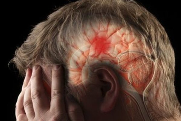 Dành ra 1 phút để cứu sống ít nhất 1 mạng người khỏi tai biến - đột quỵ